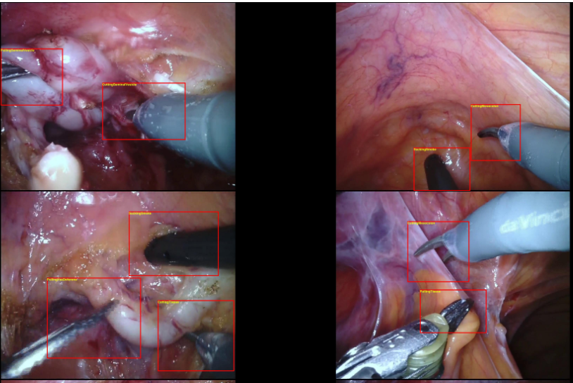 SARAS-ESAD surgical action detection dataset overview